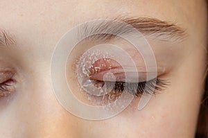 Closed eye of a little girl suffering from ocular atopic dermatitis or eyelid eczema photo