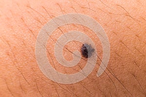 Closed up of a mole of a teenager