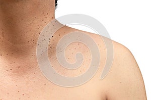 Closed up the skin tags or Seborrheic Keratosis on neck