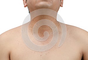 Closed up the skin tags or Seborrheic Keratosis on neck