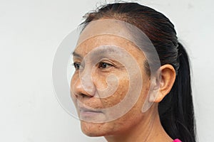 Closeuo Young woman Problem skin face blemish on white background