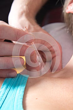 Closeup of acupuncture on female the patient neck