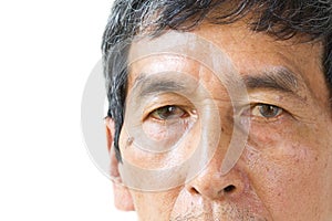 Closeup asian old man eye , his eyes are Pinguecula. photo