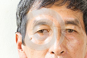 Closeup asian old man eye , his eyes are Pinguecula. photo
