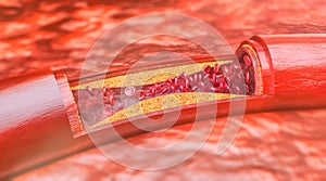 Closeup of a atherosclerosis- 3D rendering