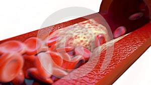 Closeup of a atherosclerosis- 3D rendering