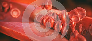 Closeup of a atherosclerosis- 3D rendering