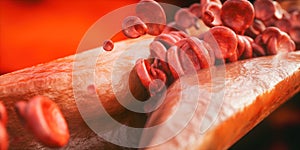 Closeup of a atherosclerosis- 3D rendering