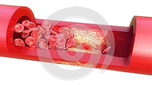 Closeup of a atherosclerosis - 3D rendering