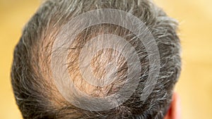 Closeup of backside of balding man