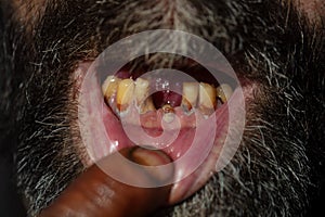 Closeup bad teeth man with caries tartar. The harm of alcohol and tobacco concept, smoker sick.