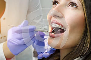 Closeup of beautiful girl on dental braces check up photo