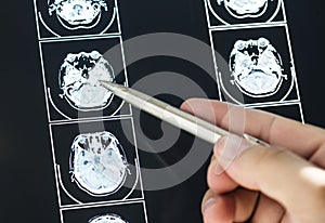 Closeup of brain MRI scan result medical concept