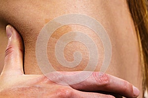 Closeup of brown birthmark on skin