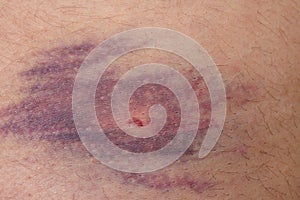 Closeup of bruise over white skin