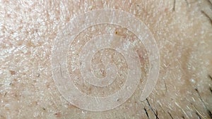 Closeup of caucasian skin with ingrown hair and man short beard. Close up of caucasian skin with many ingrown hairs concept