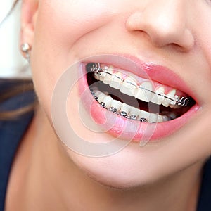 Closeup Ceramic and Metal Braces on Teeth. Beautiful Female Smil