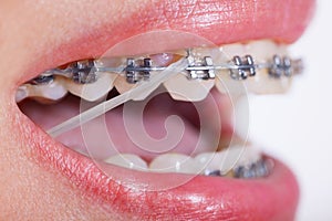 Closeup Ceramic and Metal Braces on Teeth with Elastic Rubber Ba