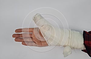 Closeup of child broken arm in cast