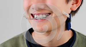 Closeup children boy wearing orthodontic appliance treatment. Dental braces with child concept.