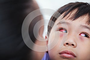 Closeup of chronic conjunctivitis with a red iris. photo