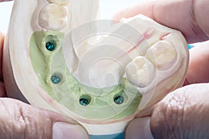 Dental implant temporary abutment photo