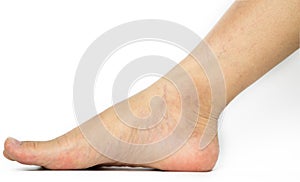 Closeup cracked heels and varicose veins on Asian woman leg and ankle isolated on white background . The problem fr