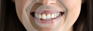 Closeup cropped lower face view woman having wide toothy smile