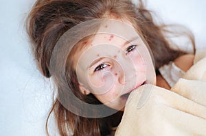 Closeup of cute sad crying little girl in bed. Varicella virus or Chickenpox bubble rash on child