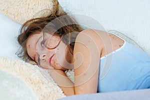 Closeup of cute sad little girl near the teddy bear. Varicella virus or Chickenpox bubble rash on child