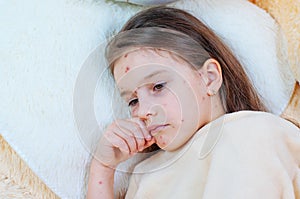 Closeup of cute sad little girl near the teddy bear. Varicella virus or Chickenpox bubble rash on child