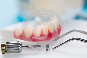 Implantes dentales soportado 