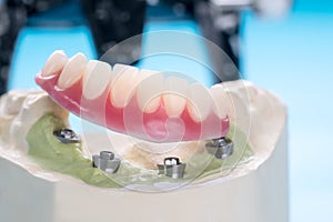 Dental implants supported overdenture. photo