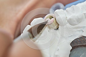 Closeup of dental technician putting ceramic to dental implants