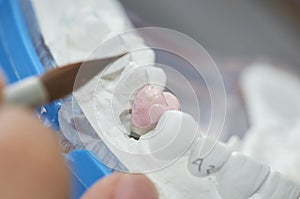 Closeup of dental technician putting ceramic to dental implants