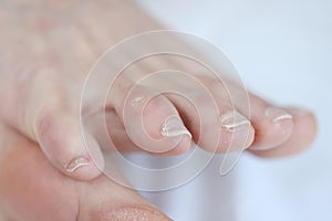 Closeup of dry callus on woman toe photo