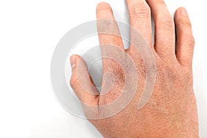 Closeup of dry cracked skin on a young male hands isolated in white background.