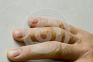 Closeup of Eczema Dermatitis on man hand and fingers. Skin peeling,desquamation of hand, gray modern background. Hand dermatitis,