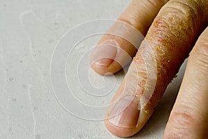 Closeup of Eczema Dermatitis on man hand and fingers. Skin peeling,desquamation of hand, gray modern background. Hand dermatitis,