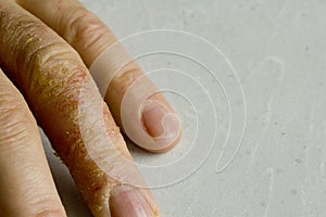 Closeup of Eczema Dermatitis on man hand and fingers. Skin peeling,desquamation of hand, gray modern background. Hand dermatitis,