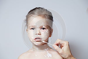 Closeup face of cute little girl with varicella virus or chickenpox bubble rash, doctor`s or mom`s hand with cotton swab coverin