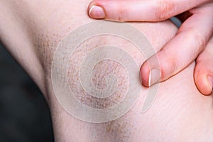 Closeup of female armpit after epilation with irritation.