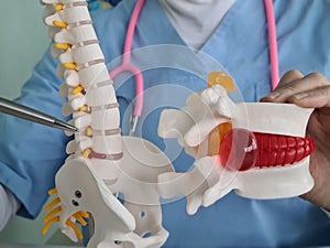 Closeup of female doctor hand with artificial disc herniation and spine model. Treatment of herniated discs and diseases