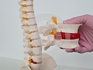Closeup of female doctor hand with artificial herniated disc and medical care structure and model of spine