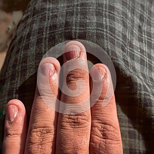 Closeup of Fingernails with vertical ridges