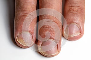Closeup of the fingers of a patient with Psoriatic onychodystrophy or psoriatic nails disease