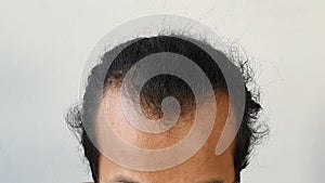 Closeup the front of head lose hair of asian man. Glabrous as V shape