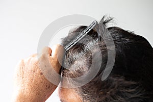 Closeup Hair grows on the head of an old woman