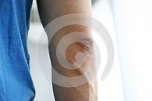 Closeup hand man in blue T-shirt with swollen vein