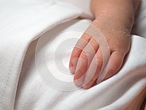 Closeup hand of a newborn with a skin peeling on white cloth. Skin allergies in newborn called Vernix. the concept of health care